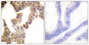 Immunohistochemical analysis of paraffin-embedded human lung carcinoma using Anti-Caspase 2 (phospho Ser157) Antibody. The right hand panel represents a negative control, where the antibody was pre-incubated with the immunising peptide.