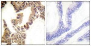 Immunohistochemical analysis of paraffin-embedded human lung cancer using Anti-Caspase 2 (phospho Ser157) Antibody 1:100 (4°C overnight). The right hand panel represents a negative control, where the antibody was pre-incubated with the immunising peptide.