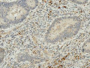 Immunohistochemistry analysis of human colon cancer, fixed in formalin and paraffin-embedded. The Primary Antibody used was Anti-IRGM Antibody (A304839) at 1:50 for 30 minutes at room temperature. Counterstain: Hematoxylin. Magnification: 20X. HRP-DAB Detection