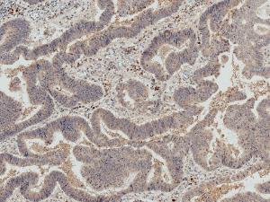 Immunohistochemistry analysis of human colon cancer, fixed in formalin and paraffin-embedded. The Primary Antibody used was Anti-IRGM Antibody (A304839) at 1:50 for 30 minutes at room temperature. Counterstain: Hematoxylin. Magnification: 10X. HRP-DAB Detection