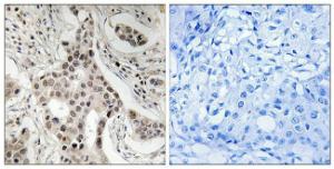 Immunohistochemical analysis of paraffin-embedded human breast carcinoma using Anti-NCoA2 (phospho Ser736) Antibody. The right hand panel represents a negative control, where the Antibody was pre-incubated with the immunising peptide