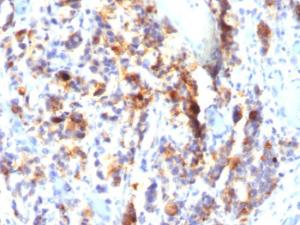 Immunohistochemical analysis of formalin-fixed, paraffin-embedded human gastric carcinoma using Anti-Mucin 5AC Antibody [SPM297]