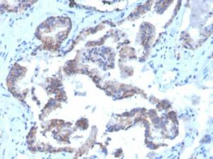 Immunohistochemical analysis of formalin-fixed, paraffin-embedded human prostate carcinoma using Anti-CD47 Antibody [CD47/3019] (Biotin)