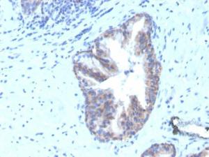 Immunohistochemical analysis of formalin-fixed, paraffin-embedded human prostate carcinoma using Anti-CD47 Antibody [CD47/3019] (Biotin)