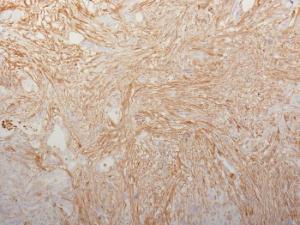 Immunohistochemical analysis of formalin-fixed, paraffin-embedded human pancreatic adenocarcinoma using Anti-Fibronectin Antibody [HFN7.1]