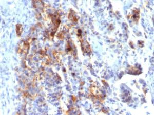 Immunohistochemical analysis of formalin-fixed, paraffin-embedded human gastric carcinoma using Anti-Mucin 5AC Antibody [45M1] (Biotin)