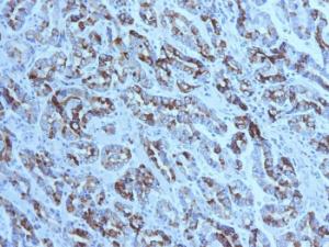 Immunohistochemical analysis of formalin-fixed, paraffin-embedded human gastric carcinoma using Anti-MUC6 Antibody [CLH5]