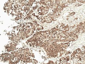 Immunohistochemistry analysis of human ovarian cancer, fixed in formalin and paraffin-embedded. The Primary Antibody used was Anti-VDAC1/Porin Antibody (A304848) at 1:50 for 30  minutes at room temperature. Counterstain: Hematoxylin. Magnification: 20X