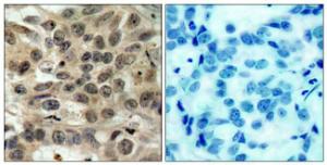 Immunohistochemical analysis of paraffin-embedded human breast carcinoma tissue using Anti-CDC25C Antibody. The right hand panel represents a negative control, where the antibody was pre-incubated with the immunising peptide.