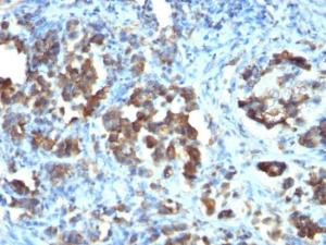 Immunohistochemical analysis of formalin-fixed, paraffin-embedded human gastric carcinoma using Anti-CDC20 Antibody [CDC20/1102]