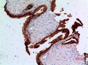 Immunohistochemical analysis of paraffin-embedded human prostatic cancer using Anti-ANGPT1 Antibody