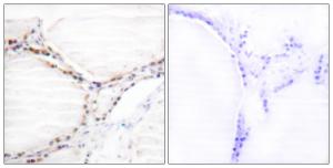 Immunohistochemical analysis of paraffin-embedded human thyroid gland tissue using Anti-Vita min D Receptor Antibody. The right hand panel represents a negative control, where the Antibody was pre-incubated with the immunising peptide