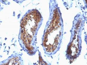 Immunohistochemical analysis of formalin-fixed, paraffin-embedded human testicular carcinoma using Anti-Major Vault Protein Antibody [SPM280]