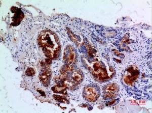 Immunohistochemical analysis of paraffin-embedded human prostatic cancer using Anti-ANGPT1 Antibody