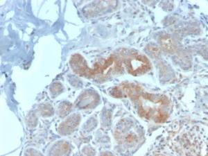 Immunohistochemical analysis of formalin-fixed, paraffin-embedded human breast carcinoma using Anti-Major Vault Protein Antibody [VP2897R]