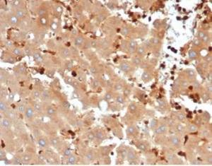 Immunohistochemical analysis of formalin-fixed, paraffin-embedded human liver carcinoma in colon tissue using Anti-FABP5 Antibody [FABP5/6353R]