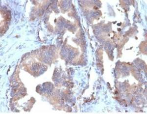 Immunohistochemical analysis of formalin-fixed, paraffin-embedded human prostate carcinoma tissue using Anti-FABP5 Antibody [FABP5/6353R]