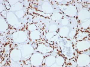 Immunohistochemical analysis of formalin-fixed, paraffin-embedded human angiosarcoma using Anti-Histone H1 Antibody [SPM256]