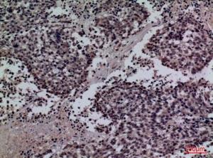 Immunohistochemical analysis of paraffin-embedded human lung cancer using Anti-SFTPA1 + SFTPA2 Antibody