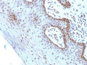 Immunohistochemical analysis of formalin-fixed, paraffin-embedded human cervical carcinoma using Anti-c-Myc Antibody [SPM237]