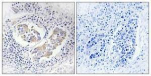 Immunohistochemical analysis of paraffin-embedded human lung cancer using Anti-AKR1B1 Antibody 1:100 (4°C overnight). The right hand panel represents a negative control, where the antibody was pre-incubated with the immunising peptide