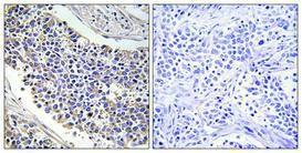 Immunohistochemical analysis of paraffin-embedded human lung cancer using Anti-AKR1B1 Antibody 1:100 (4°C overnight). The right hand panel represents a negative control, where the antibody was pre-incubated with the immunising peptide