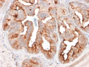 Immunohistochemical analysis of formalin-fixed, paraffin-embedded human prostate carcinoma using Anti-PSMA Antibody [FOLH1/2354]