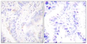 Immunohistochemical analysis of paraffin-embedded human lung carcinoma tissue using Anti-CrkII Antibody. The right hand panel represents a negative control, where the antibody was pre-incubated with the immunising peptide