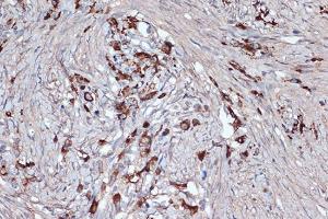 Immunohistochemistry analysis of paraffin-embedded human oophoroma using Anti-Xanthine Oxidase Antibody [ARC1385] (A308953) at a dilution of 1:100 (40X lens). Perform microwave antigen retrieval with 10 mM Tris/EDTA buffer pH 9.0 before commencing with IHC staining protocol