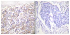 Immunohistochemical analysis of paraffin-embedded human breast carcinoma tissue using Anti-TNF Receptor I Antibody. The right hand panel represents a negative control, where the Antibody was pre-incubated with the immunising peptide