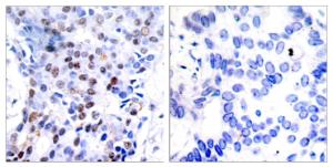 Immunohistochemical analysis of paraffin-embedded human breast carcinoma tissue using Anti-c-Jun Antibody. The right hand panel represents a negative control, where the antibody was pre-incubated with the immunising peptide