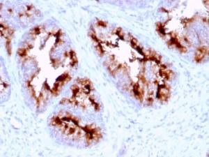 Immunohistochemical analysis of formalin-fixed, paraffin-embedded human prostate carcinoma using Anti-PSMA Antibody [FOLH1/2363]