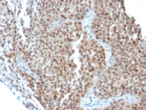 Immunohistochemical analysis of formalin-fixed, paraffin-embedded human bladder carcinoma using Anti-p21 Antibody [CIP1/823 + DCS-60.2]