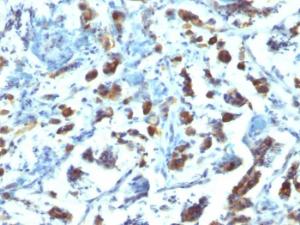 Immunohistochemical analysis of formalin-fixed, paraffin-embedded human gastric carcinoma using Anti-MUC3 Antibody [SPM200]