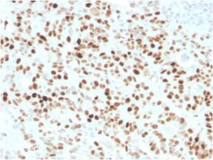 Immunohistochemical analysis of formalin-fixed, paraffin-embedded human colon carcinoma using Anti-p21 Antibody [CIP1/4377R]