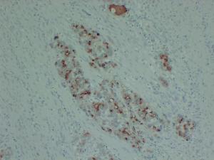 Immunohistochemical analysis of paraffin-embedded human Gastric adenocarcinoma using Anti-PIK3CA H1047R Antibody