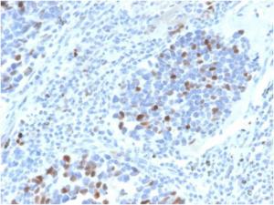 Immunohistochemical analysis of formalin-fixed, paraffin-embedded human lungcarcinoma using Anti-p21 Antibody [CIP1/4377R]