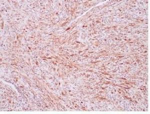 Immunohistochemical analysis of formalin-fixed, paraffin-embedded human inflammatory myofibroblastic tumor (IMT) with ALK fusion tissue using Anti-ALK Antibody [ALK1/7008R]