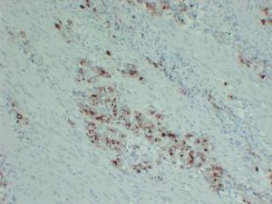 Immunohistochemical analysis of paraffin-embedded human Gastric adenocarcinoma using Anti-PIK3CA H1047R Antibody