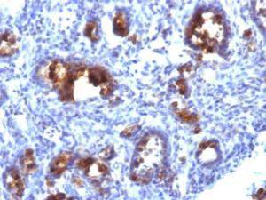 Immunohistochemical analysis of formalin-fixed, paraffin-embedded human gastric carcinoma using Anti-MUC3 Antibody [MUC3/1154]