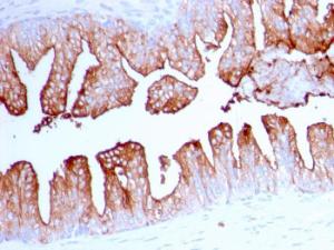 Immunohistochemical analysis of formalin-fixed, paraffin-embedded human prostate cancer using Anti-PSMA Antibody [FOLH1/2363]