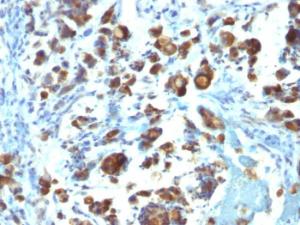 Immunohistochemical analysis of formalin-fixed, paraffin-embedded human gastric carcinoma using Anti-MUC3 Antibody [MUC3/1154]