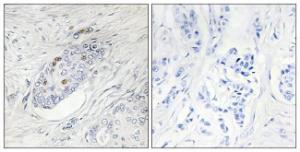 Immunohistochemical analysis of paraffin-embedded human breast carcinoma using Anti-ZNF232 Antibody. The right hand panel represents a negative control, where the antibody was pre-incubated with the immunising peptide