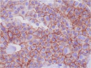 Immunohistochemical analysis of formalin-fixed, paraffin-embedded human breast adenocarcinoma using Anti-E Cadherin Antibody [CDH1/1525]