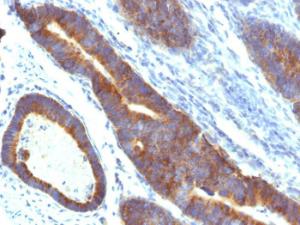 Immunohistochemical analysis of formalin-fixed, paraffin-embedded human colon carcinoma using Anti-MUC3 Antibody [MUC3/1154]