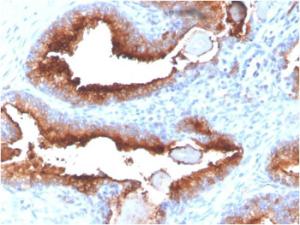 Immunohistochemical analysis of formalin-fixed, paraffin-embedded human prostate carcinoma using Anti-PSMA Antibody [FOLH1/3734]