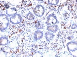 Immunohistochemical analysis of formalin-fixed, paraffin-embedded human gastric carcinoma using Anti-MUC3 Antibody [MUC3/2992R]