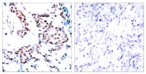 Immunohistochemical analysis of paraffin-embedded human breast carcinoma tissue using Anti-c-Jun Antibody. The right hand panel represents a negative control, where the antibody was pre-incubated with the immunising peptide