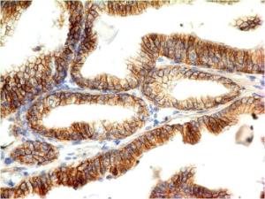 Immunohistochemical analysis of formalin-fixed, paraffin-embedded colon carcinoma using Anti-E Cadherin Antibody [CDH1/1525]