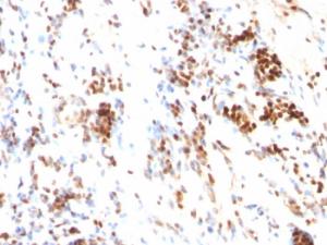 Immunohistochemical analysis of formalin-fixed, paraffin-embedded human colon cancer using Anti-p27 KIP 1 Antibody [DCS-72.F6]